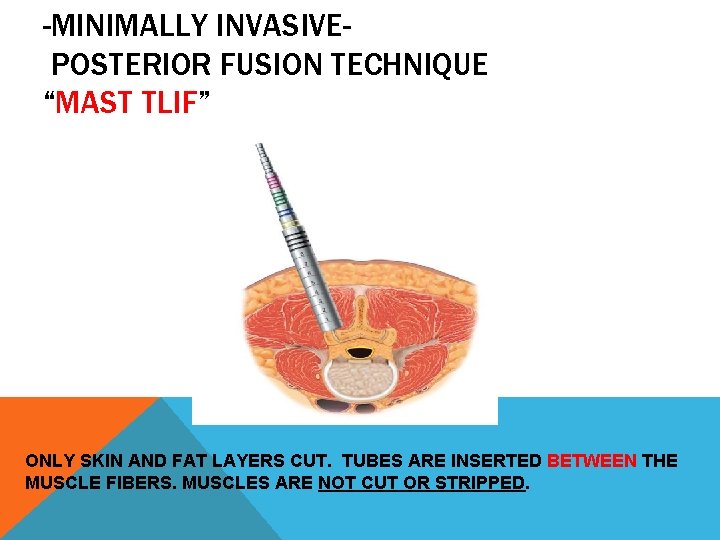 -MINIMALLY INVASIVEPOSTERIOR FUSION TECHNIQUE “MAST TLIF” ONLY SKIN AND FAT LAYERS CUT. TUBES ARE
