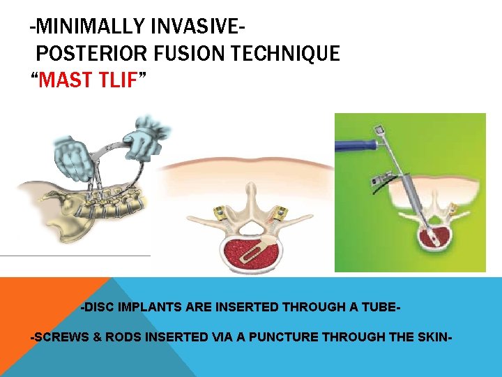 -MINIMALLY INVASIVEPOSTERIOR FUSION TECHNIQUE “MAST TLIF” -DISC IMPLANTS ARE INSERTED THROUGH A TUBE-SCREWS &