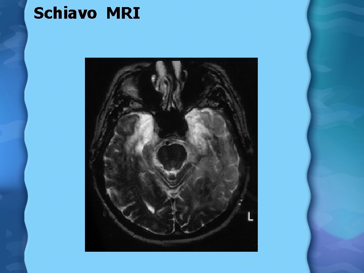 Schiavo MRI 