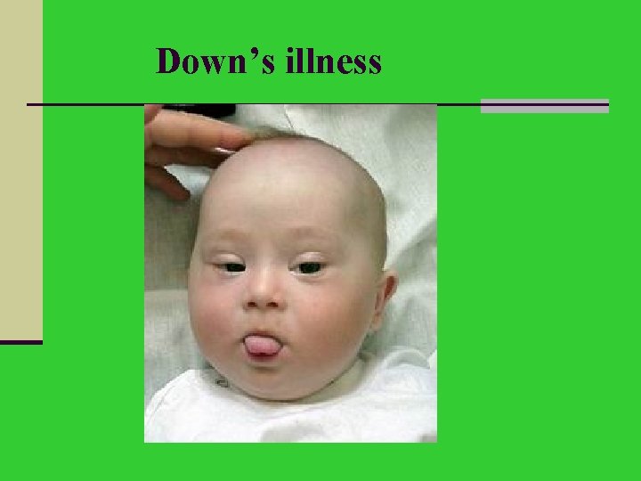 Down’s illness 