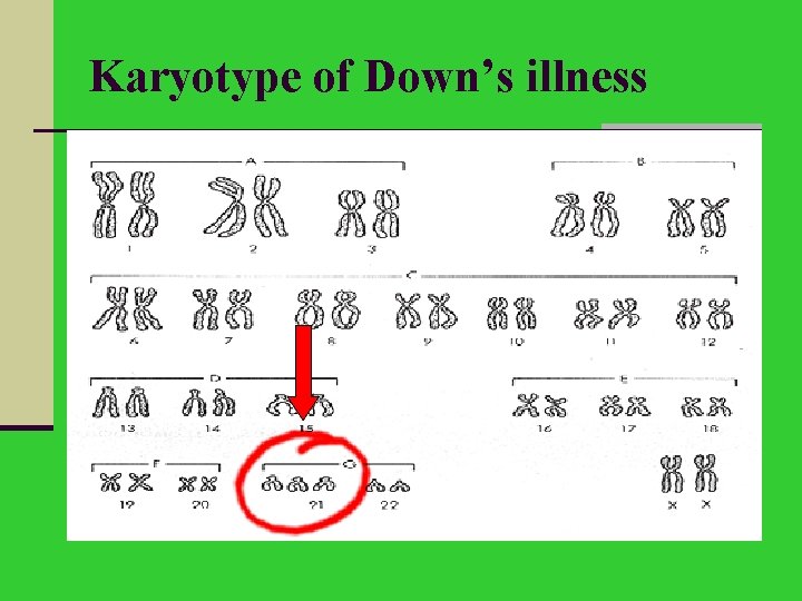 Karyotype of Down’s illness 