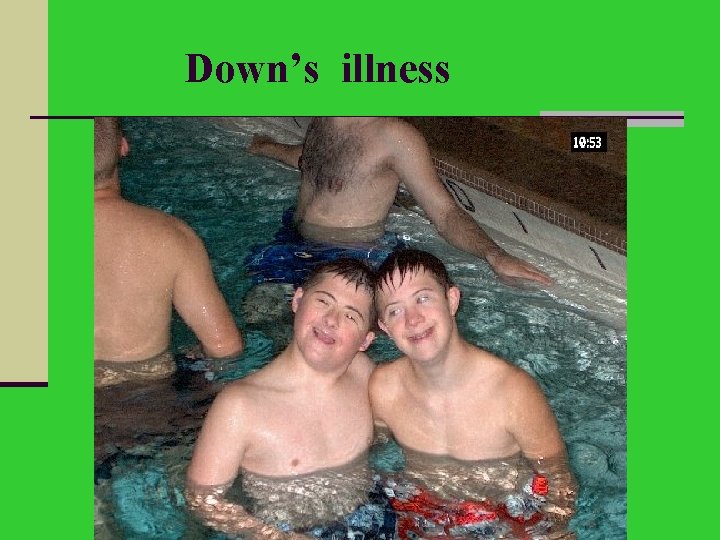 Down’s illness 