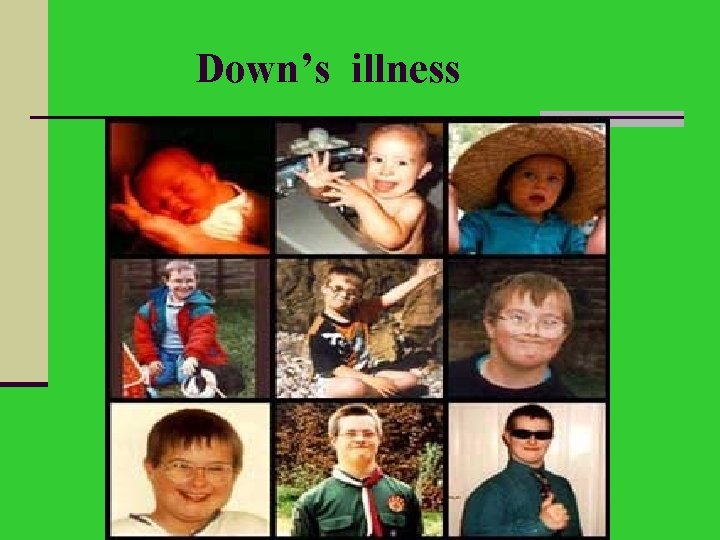 Down’s illness 