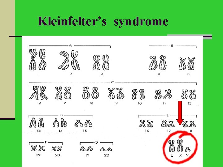 Kleinfelter’s syndrome 