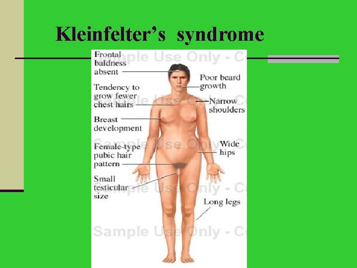 Kleinfelter’s syndrome 