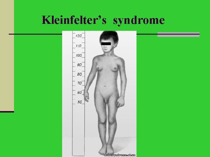 Kleinfelter’s syndrome 