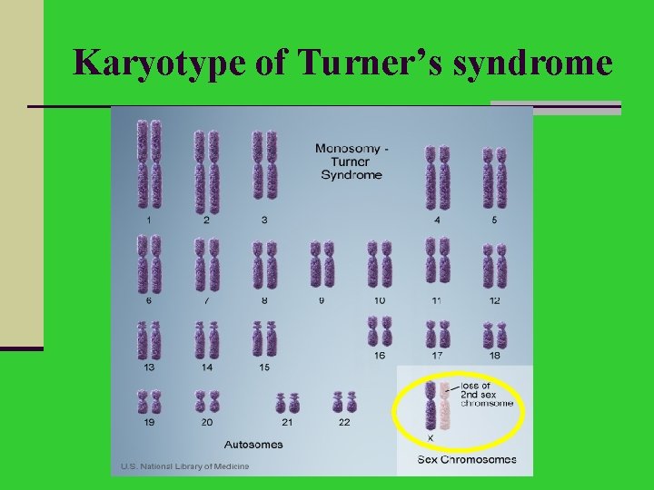 Karyotype of Turner’s syndrome 