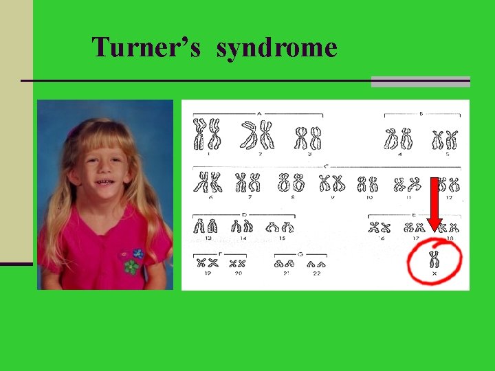 Turner’s syndrome 