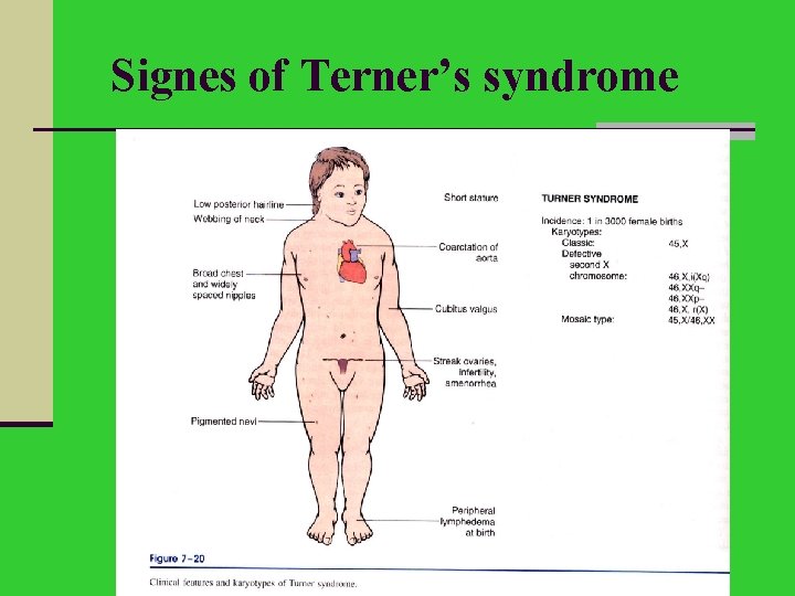 Signes of Terner’s syndrome 