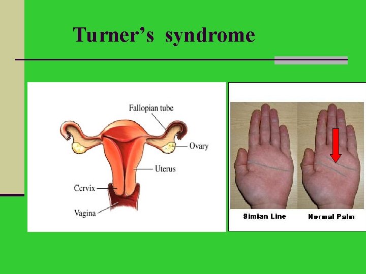 Turner’s syndrome 