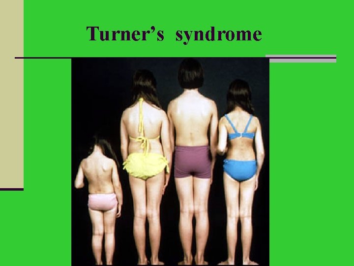 Turner’s syndrome 