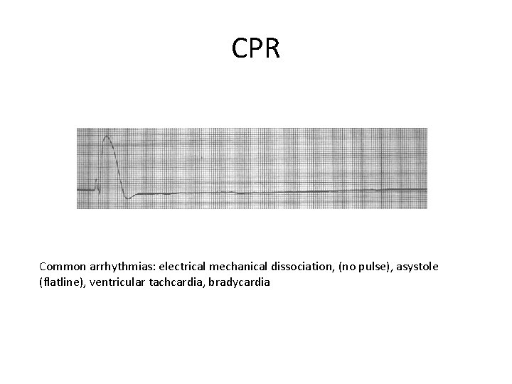 CPR Common arrhythmias: electrical mechanical dissociation, (no pulse), asystole (flatline), ventricular tachcardia, bradycardia 