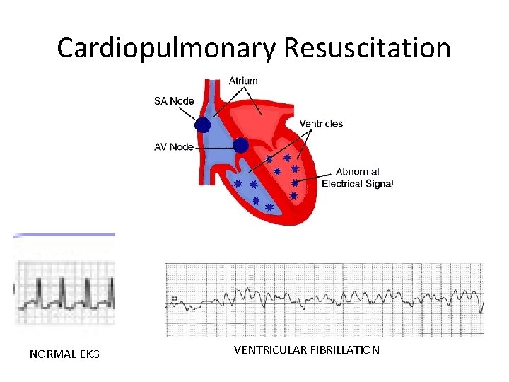 Cardiopulmonary Resuscitation NORMAL EKG VENTRICULAR FIBRILLATION 