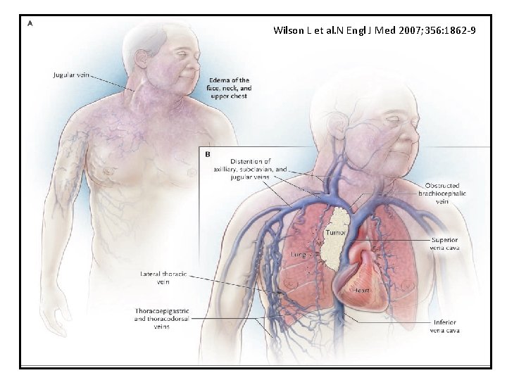 Wilson L et al. N Engl J Med 2007; 356: 1862 -9 