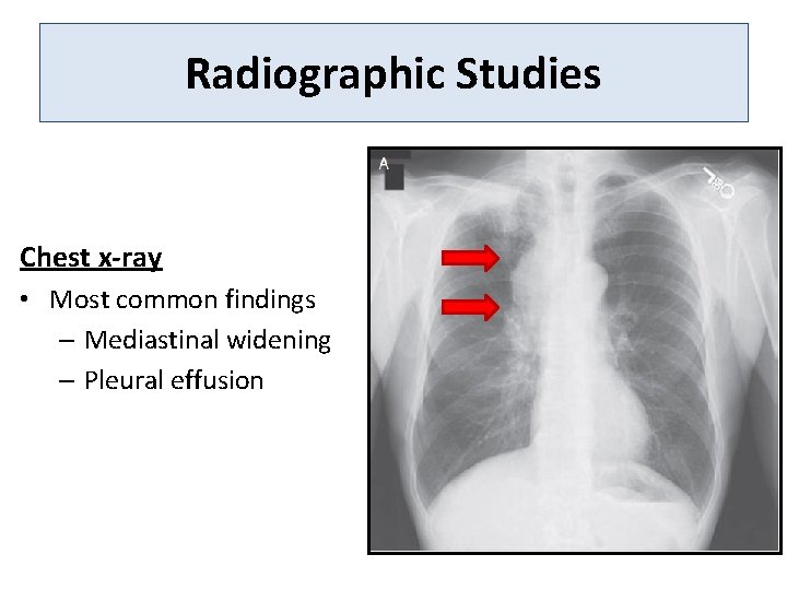 Radiographic Studies Chest x-ray • Most common findings – Mediastinal widening – Pleural effusion