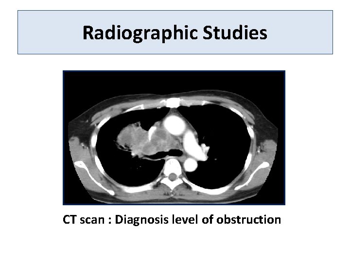 Radiographic Studies CT scan : Diagnosis level of obstruction 