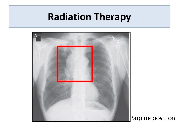 Radiation Therapy Supine position 