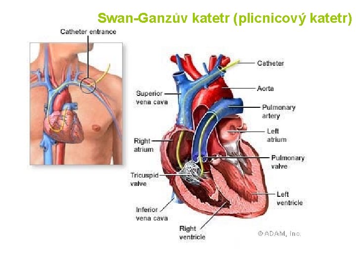 Swan-Ganzův katetr (plicnicový katetr) 
