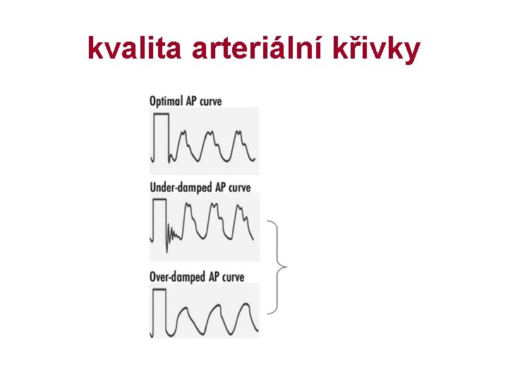 kvalita arteriální křivky 
