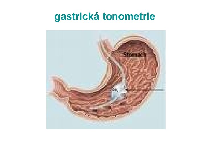 gastrická tonometrie 