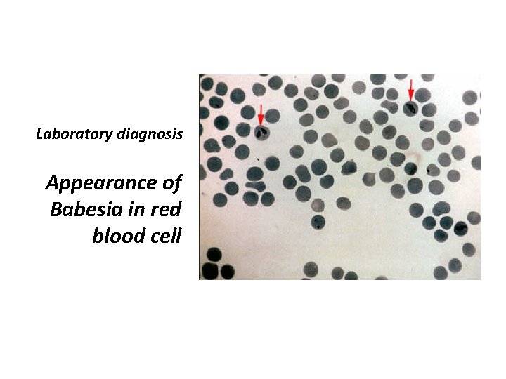Laboratory diagnosis Appearance of Babesia in red blood cell 