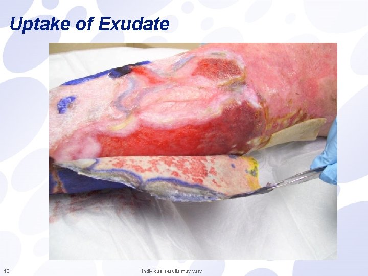 Uptake of Exudate 10 Individual results may vary 
