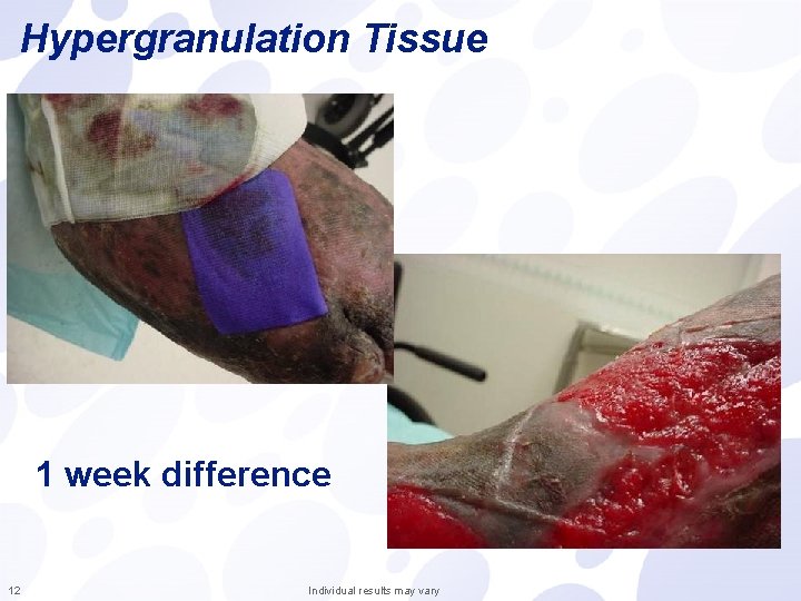 Hypergranulation Tissue 1 week difference 12 Individual results may vary 