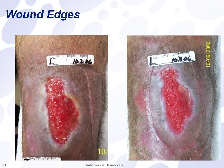 Wound Edges 13 Individual results may vary 