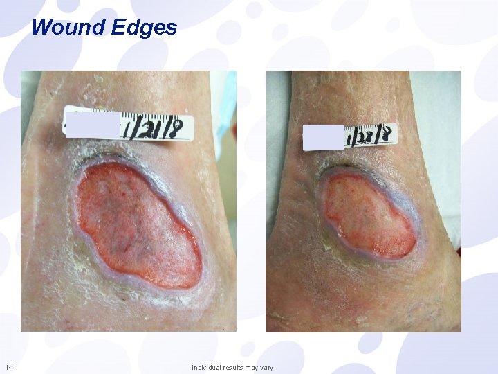 Wound Edges 14 Individual results may vary 