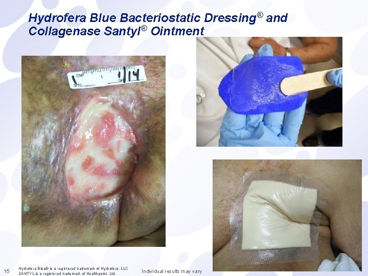 Hydrofera Blue Bacteriostatic Dressing® and Collagenase Santyl® Ointment 15 Hydrofera Blue® is a registered