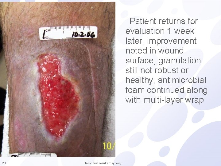 Patient returns for evaluation 1 week later, improvement noted in wound surface, granulation still