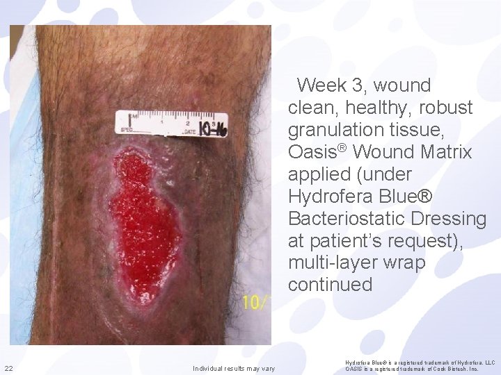 Week 3, wound clean, healthy, robust granulation tissue, Oasis® Wound Matrix applied (under Hydrofera