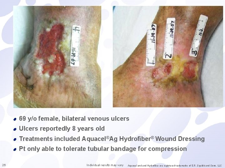 69 y/o female, bilateral venous ulcers Ulcers reportedly 8 years old Treatments included Aquacel®Ag