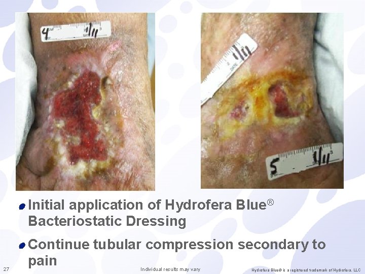 Initial application of Hydrofera Blue® Bacteriostatic Dressing 27 Continue tubular compression secondary to pain