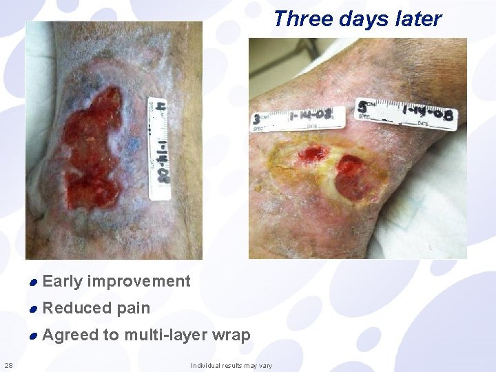 Three days later Early improvement Reduced pain Agreed to multi-layer wrap 28 Individual results