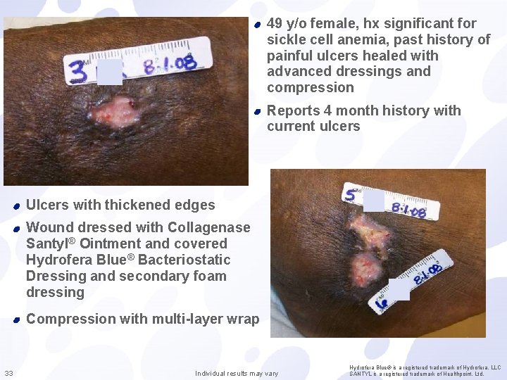 49 y/o female, hx significant for sickle cell anemia, past history of painful ulcers