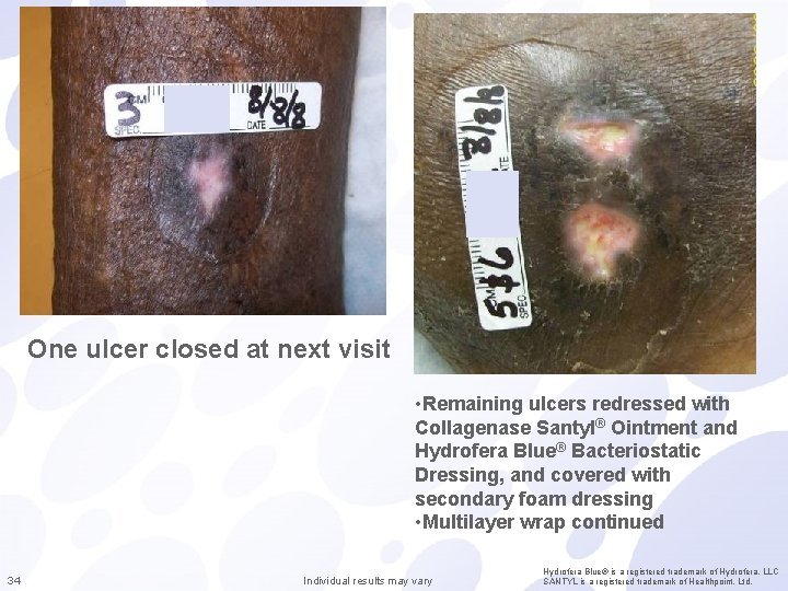 One ulcer closed at next visit • Remaining ulcers redressed with Collagenase Santyl® Ointment