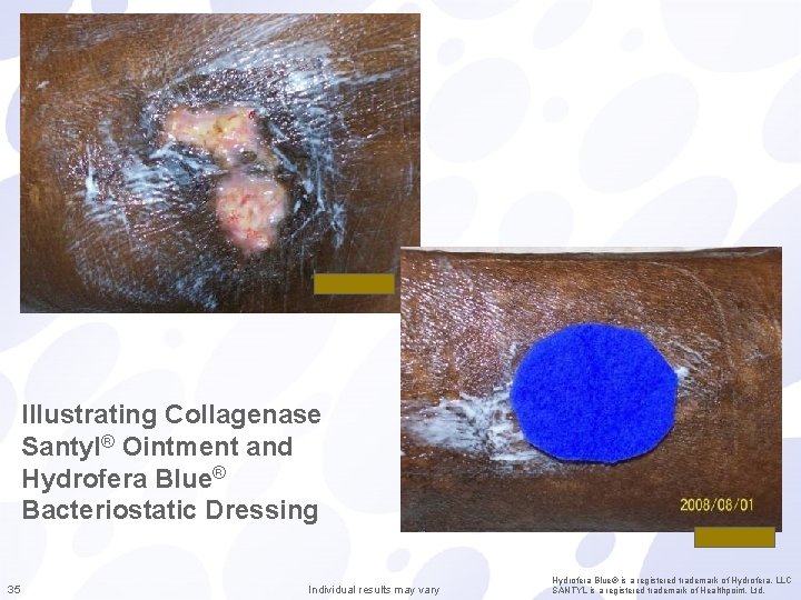 Illustrating Collagenase Santyl® Ointment and Hydrofera Blue® Bacteriostatic Dressing 35 Individual results may vary