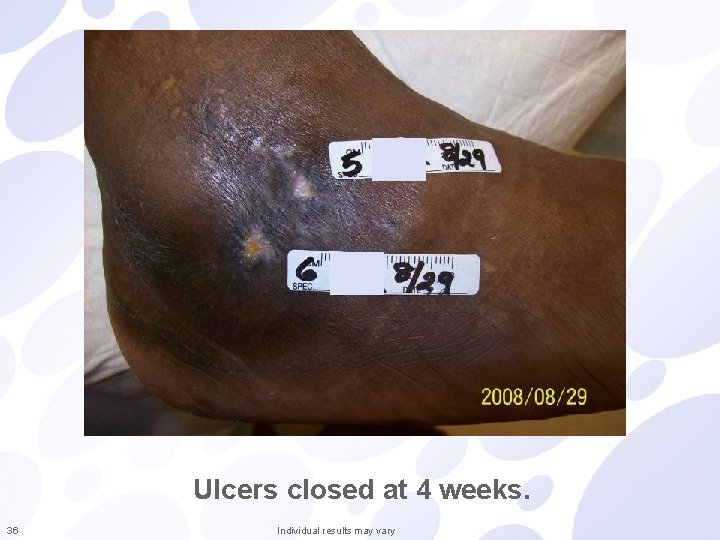 Ulcers closed at 4 weeks. 36 Individual results may vary 