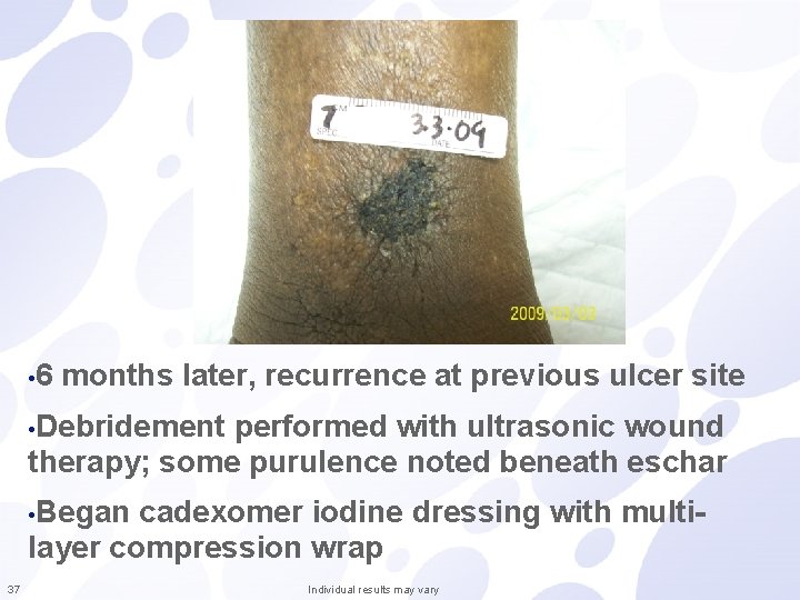  • 6 months later, recurrence at previous ulcer site • Debridement performed with