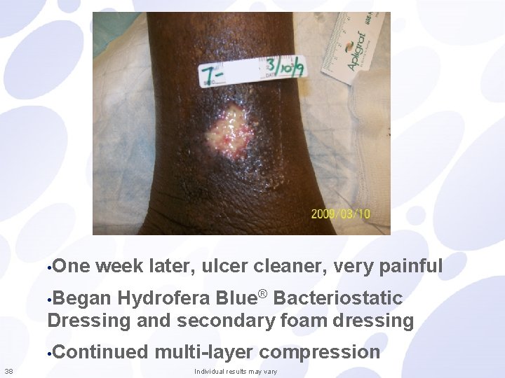  • One week later, ulcer cleaner, very painful • Began Hydrofera Blue® Bacteriostatic