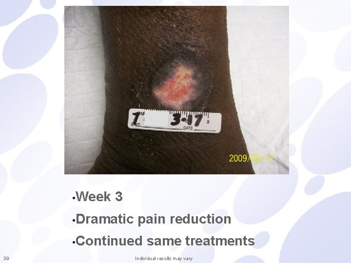  • Week 3 • Dramatic pain reduction • Continued 39 same treatments Individual