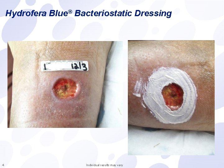 Hydrofera Blue® Bacteriostatic Dressing 4 Individual results may vary 