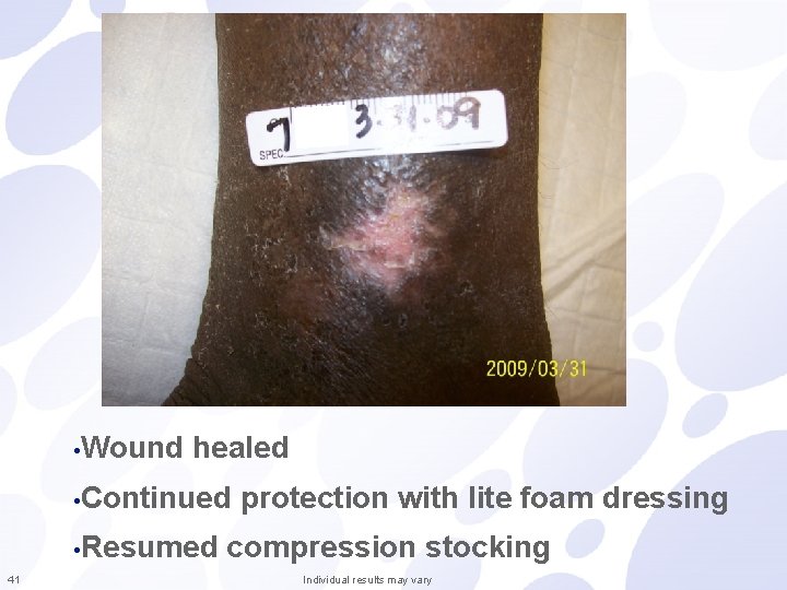  • Wound healed • Continued • Resumed 41 protection with lite foam dressing