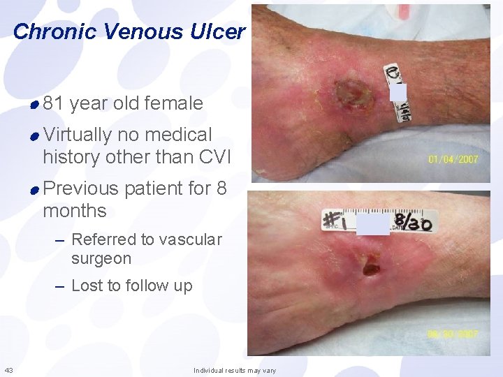 Chronic Venous Ulcer 81 year old female Virtually no medical history other than CVI