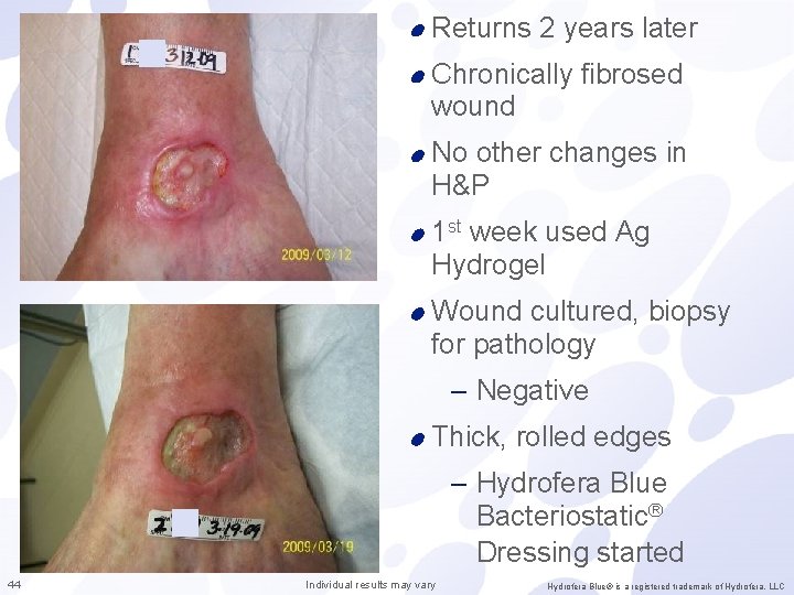 Returns 2 years later Chronically fibrosed wound No other changes in H&P 1 st