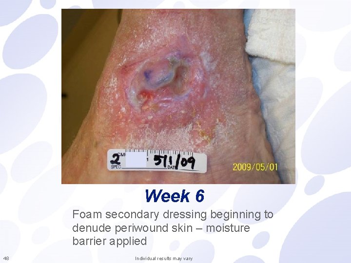 Week 6 Foam secondary dressing beginning to denude periwound skin – moisture barrier applied