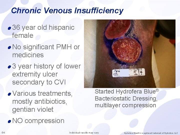 Chronic Venous Insufficiency 36 year old hispanic female No significant PMH or medicines 3