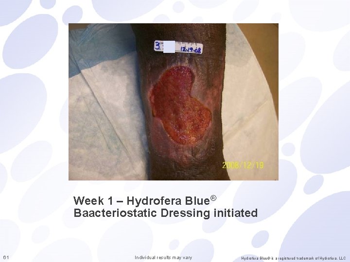 Week 1 – Hydrofera Blue® Baacteriostatic Dressing initiated 61 Individual results may vary Hydrofera