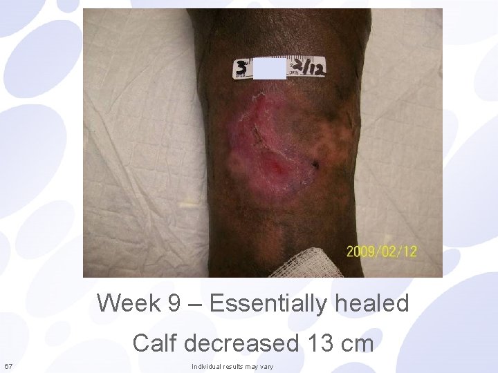 Week 9 – Essentially healed Calf decreased 13 cm 67 Individual results may vary